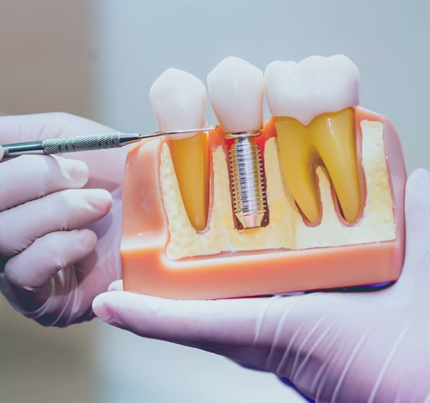 Dental Implants Salaberry