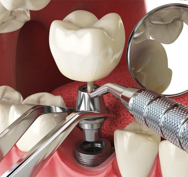 Dental Implants Salaberry