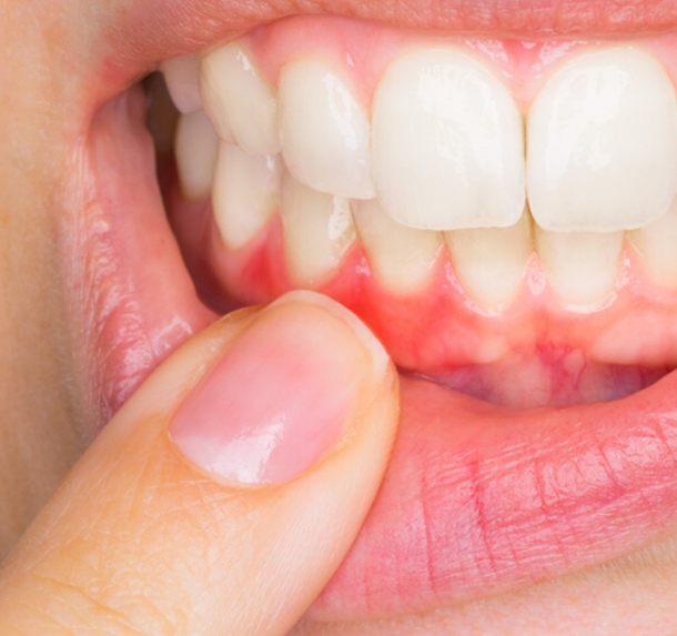Gum Graft Salaberry
