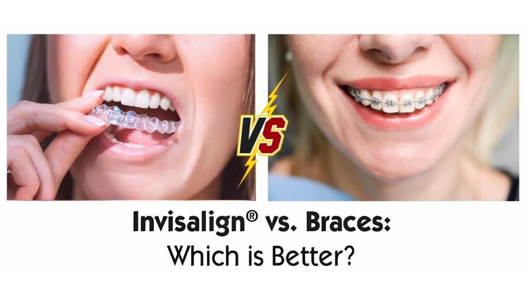 Invisalign vs Braces