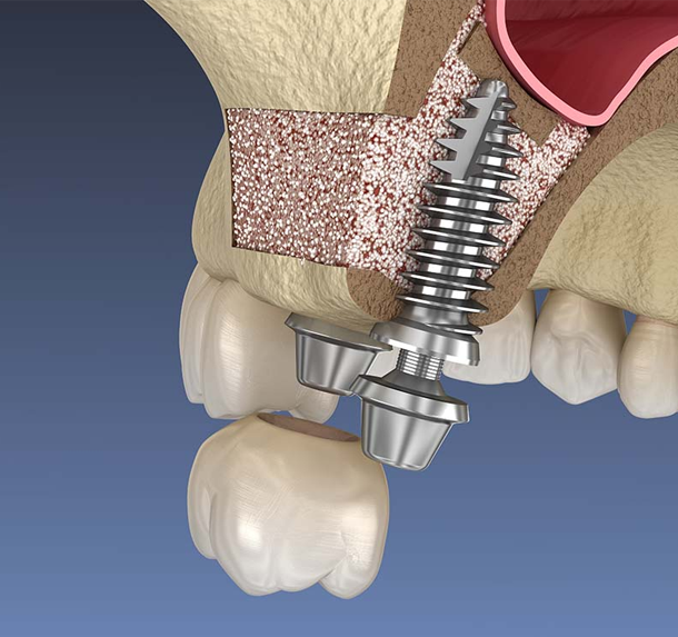 sinus Lift and Bone Graft salaberry