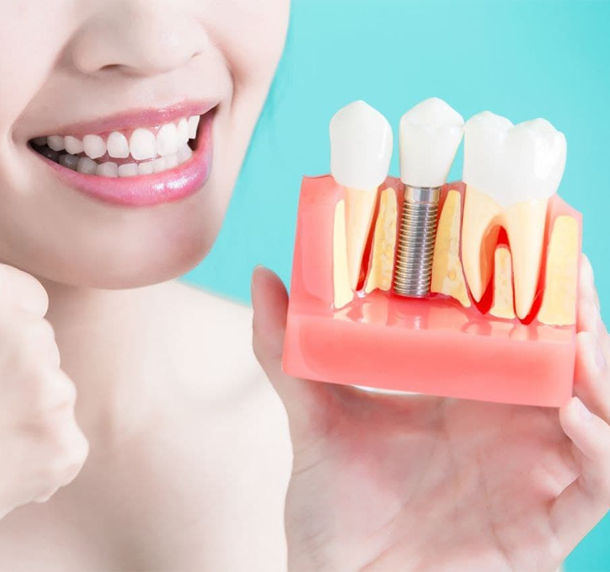 Dental Implants verdun