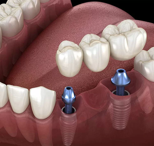 Dental implants westmount