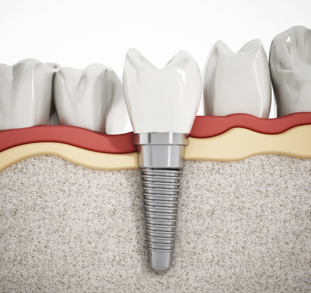 Dental Implants wesmount