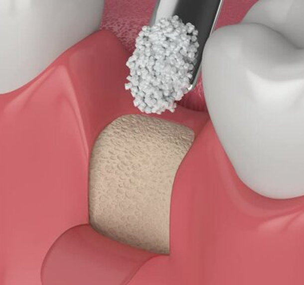 Gum Graft Westmount