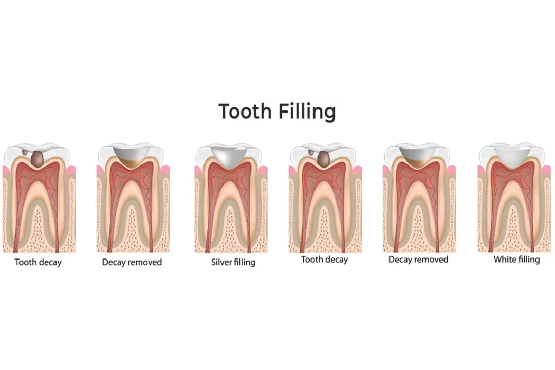 Cost dental fillings