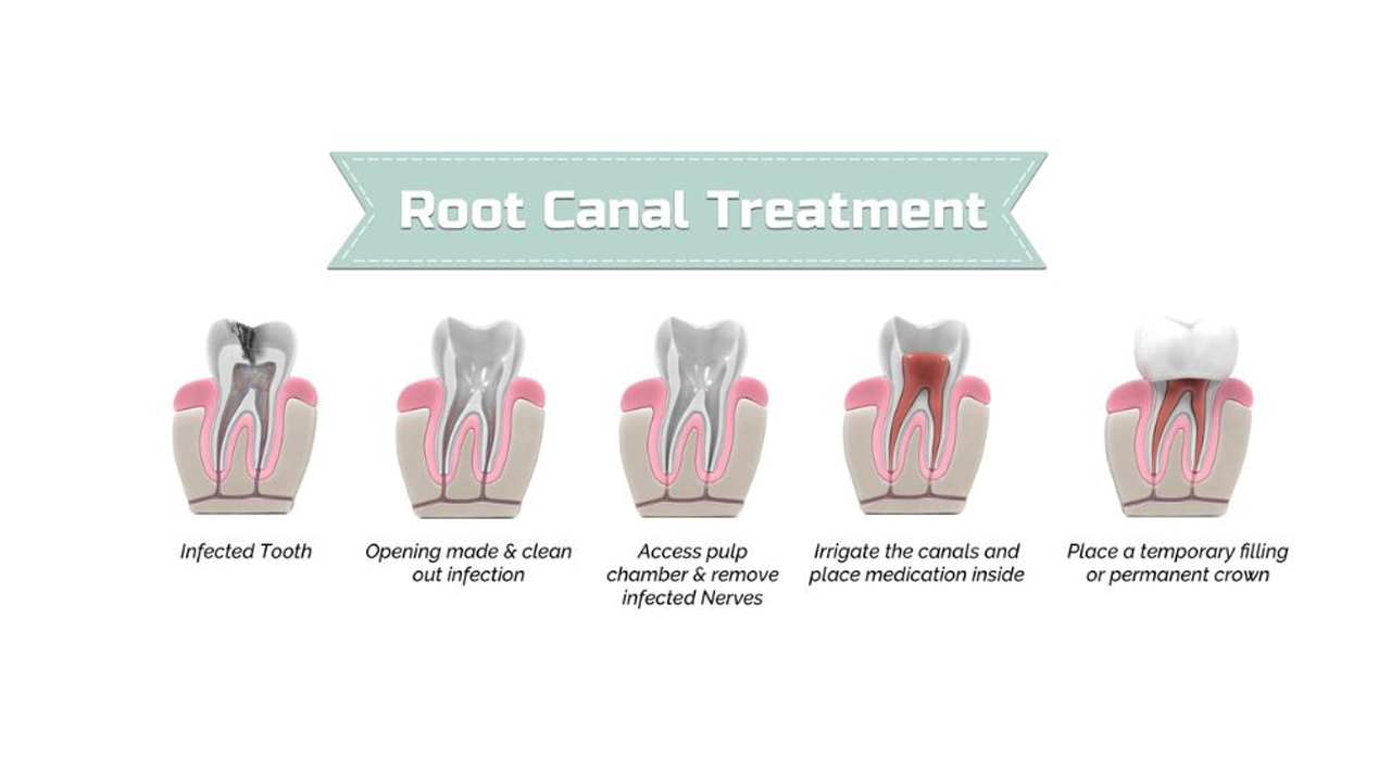 Root canal recovery