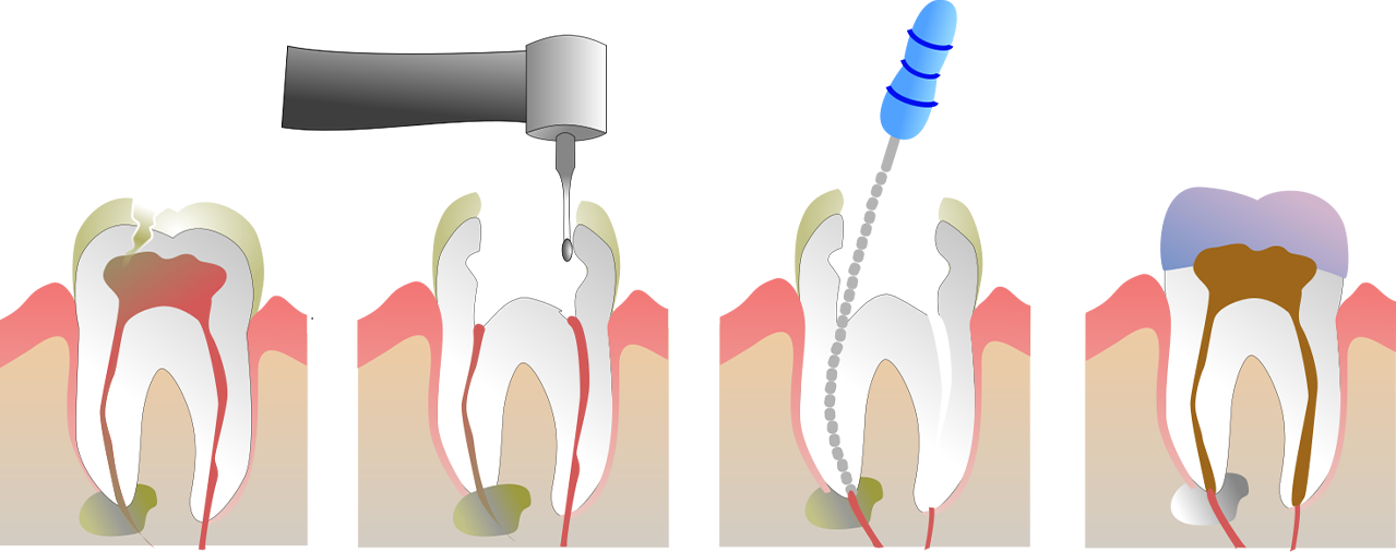 How long does a root canal take