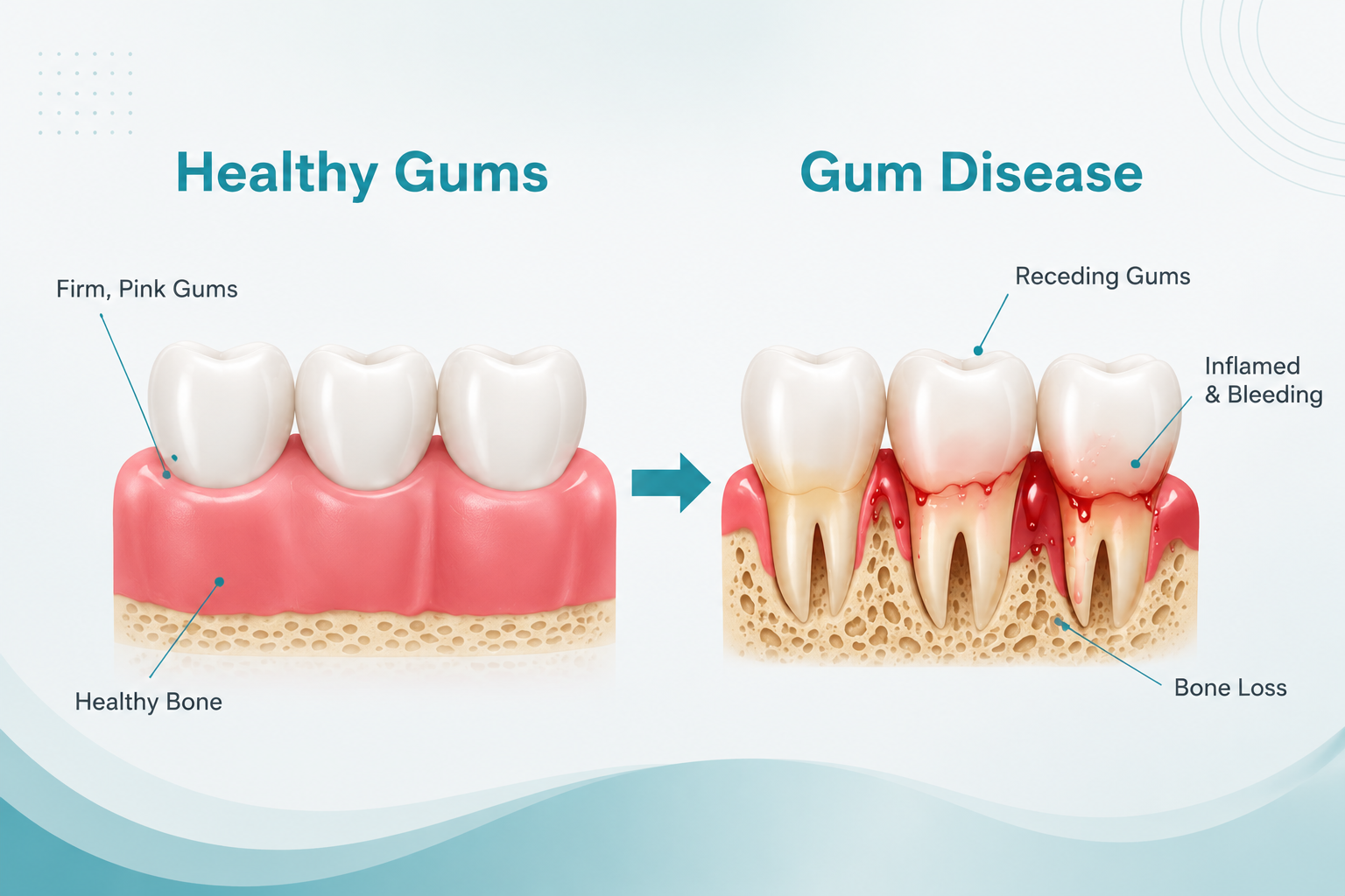 Gum Disease