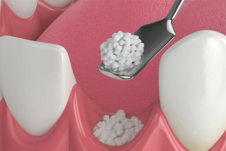 Sinus Lift and Bone Grafting Sinus Lift and Bone Grafting